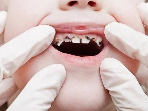 Điều cần làm ngay khi phát hiện răng trẻ có dấu hiệu bất thường